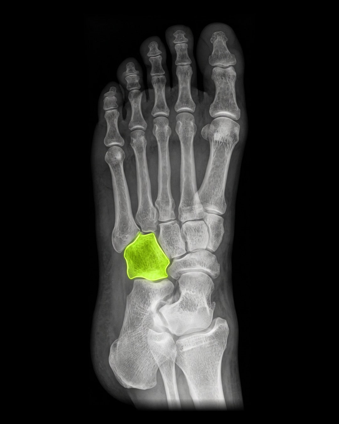 Cuboid Support Insoles - Caterpy